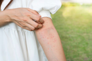prirodni lekovi za alergijski dermatitis