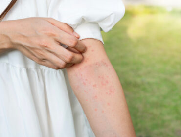 prirodni lekovi za alergijski dermatitis