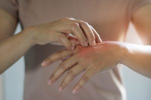 Dermatitis: Problemi s kožom tokom zime