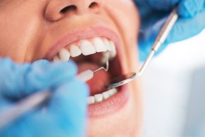Parodontoza: Šta je uzrokuje, kako se leči i koji narodni lekovi mogu pomoći