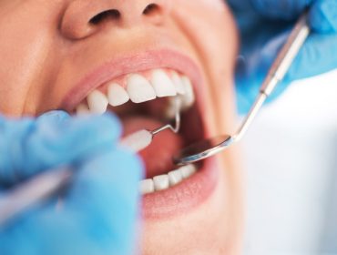 Parodontoza: Šta je uzrokuje, kako se leči i koji narodni lekovi mogu pomoći